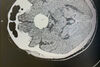 Д-р Димитър Попов диагностицира тумор в мозъка след очен преглед