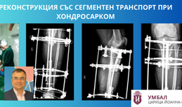 Проф. д-р Кинов спаси крака на пациент с хондросарком, 16-сантиметров дефект и тежка инфекция