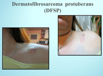 Нашият опит при диагностиката и лечението на dermatofibrosarcoma protuberans