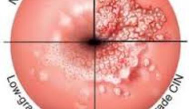 "Раничка" на маточната шийка. Рак на маточната шийка. HPV инфекция. Ваксини срещу HPV.