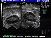 PCOS /Polycystic ovary syndrome/. Синдром на поликистозните яйчници.