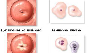 Карциномът на шийката на матката, едно от най-сериозните онкогинекологични заболявания