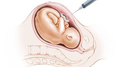 Рискове за бременността, които крият амниоцентезата и хорионната биопсия