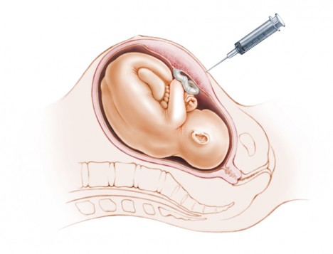 Рискове за бременността, които крият амниоцентезата и хорионната биопсия