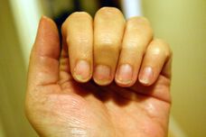 Лазерно лечение на гъбички по ноктите