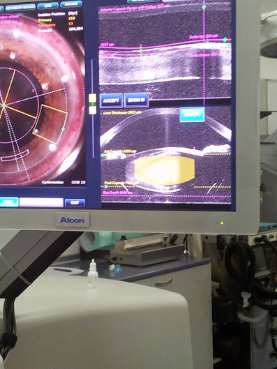 Шестима прогледнаха след операции на катаракта с 3D лазер в очна болница „Луксор“ в Пловдив