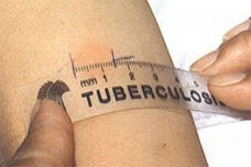 Туберкулозата е инфекциозно заболяване, съпътстващо човечеството от дълбока древност