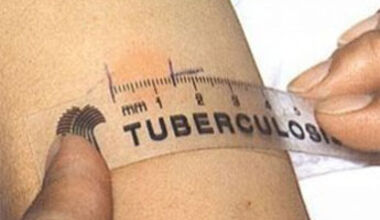 Туберкулозата е инфекциозно заболяване, съпътстващо човечеството от дълбока древност