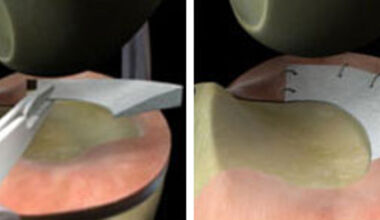 Модерна операция на менискус запазва движението на колянната става (ВИДЕО)