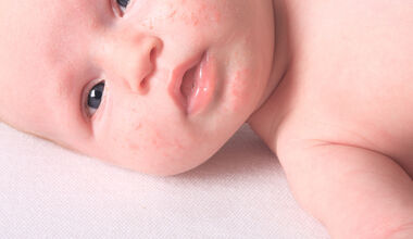 Ротавирусната инфекция може да доведе до тежко обезводняване на детето