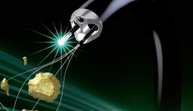 Лазер буквално разпрашава камък в пикочния мехур