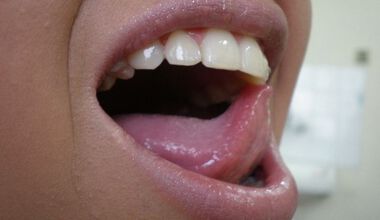 Избелване на зъби- как протича процедурата и какви са реалните резултати от нея?