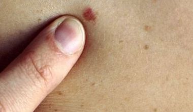 Профилактични прегледи за рак на кожата