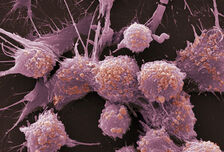 Значимостта на циркулиращите туморни клетки при пациенти с рак на простатата, подложени на лъчетерапия