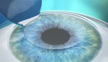 Лазерна корекция на зрението - какво да очакваме преди, по време и след процедурата