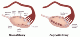  Синдром на поликистозни яйчници и карциномен риск (презентация)