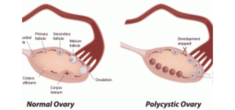  Синдром на поликистозни яйчници и карциномен риск (презентация)