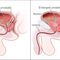 Карцином на простатата - диагностика и лечение