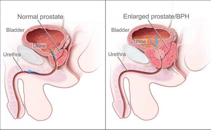 Карцином на простатата - диагностика и лечение