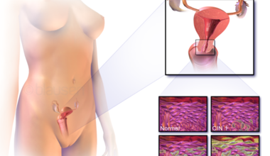 Какво представлява ракът на маточната шийка ? - Част 1