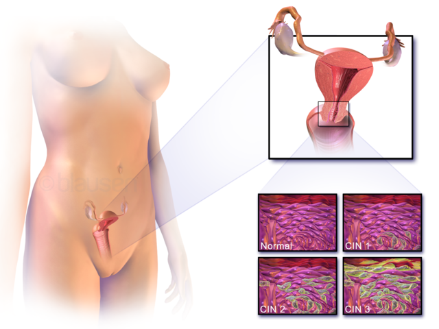 Какво представлява ракът на маточната шийка ? - Част 2