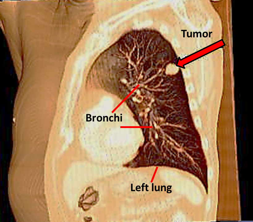 Какво представлява рак на белия дроб? - Част 2