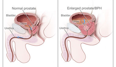 Заболяванията на простатата засягат и по-млади мъже