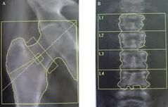 Остеодензитометрия - съвременно изследване за остеопороза