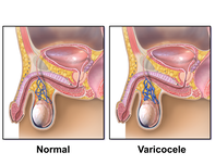 Варикоцеле води до безплодие при мъжа и се лекува само хирургично