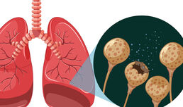 Познавате ли симптомите на туберкулозата?