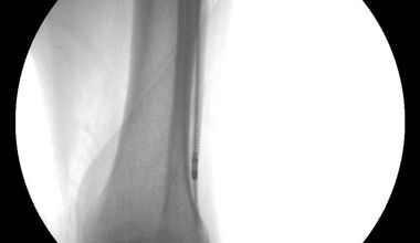 В УМБАЛ „Дева Мария” успешно реваскуларизират подколенни артерии по авангардна методика с апарата Ротарекс 