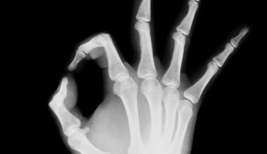 Има ли риск при рентгеново изследване?