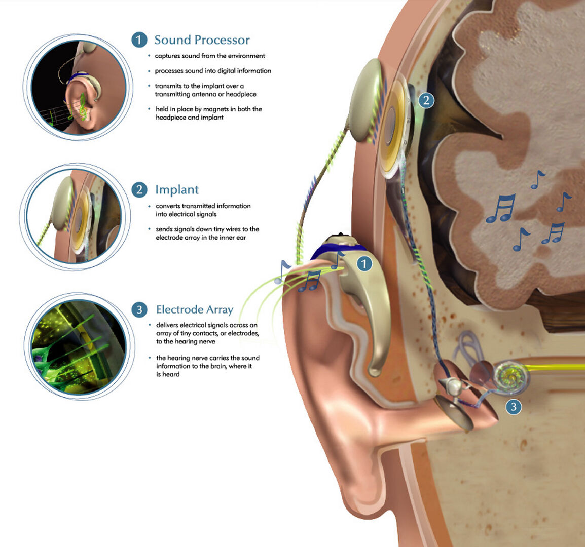 Лучший кохлеарный имплант. Электроды кохлеарных имплантов. Инфографика кохлеарная имплантация. Капиллярная имплантация. Кохлеарный имплант нерв.