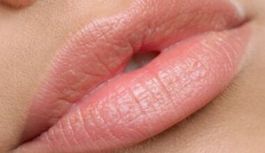 Оформяне на устни с хиалуронова киселина