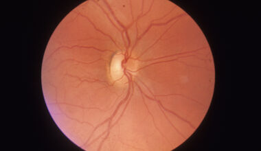 Хередитарна оптична невропатия (атрофия)  на Лебер