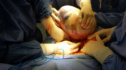 12-килограмов тумор извадиха от пациенка лекарите от екипа на проф. Горчев в МБАЛ „Света Марина“ – Плевен