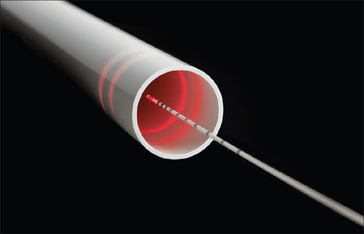 Ендовенозна лазерна аблация (ELVeS) - новият световен златен стандарт в лечението на разширени вени