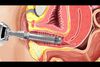 INCONTI LASE® 

нехирургично и неинвазивно лечение на симптомите на стрес-интконтиненция

с иновативна лазерна система - Vaginal Erbium Laser