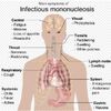 Инфекциозна мононуклеоза