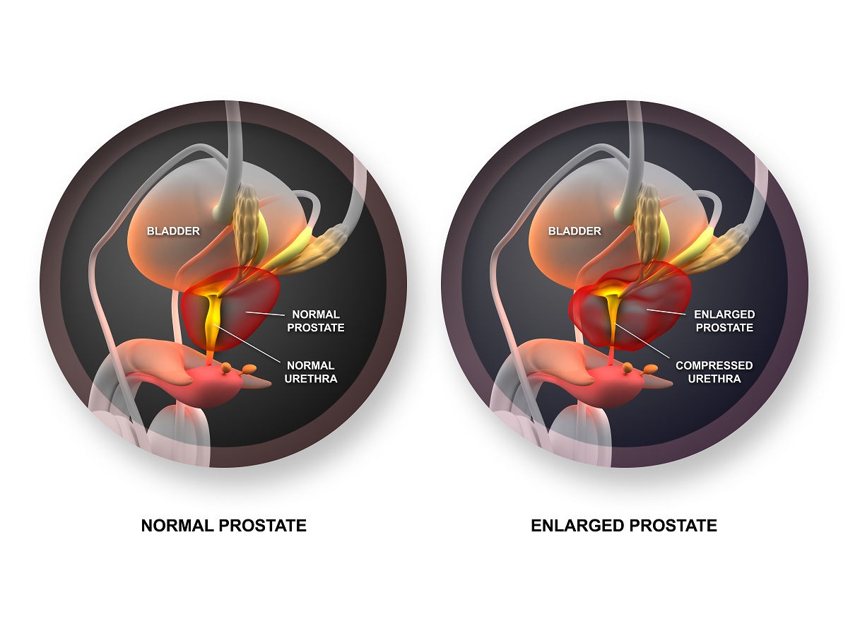 безкръвно изпаряване на простатата