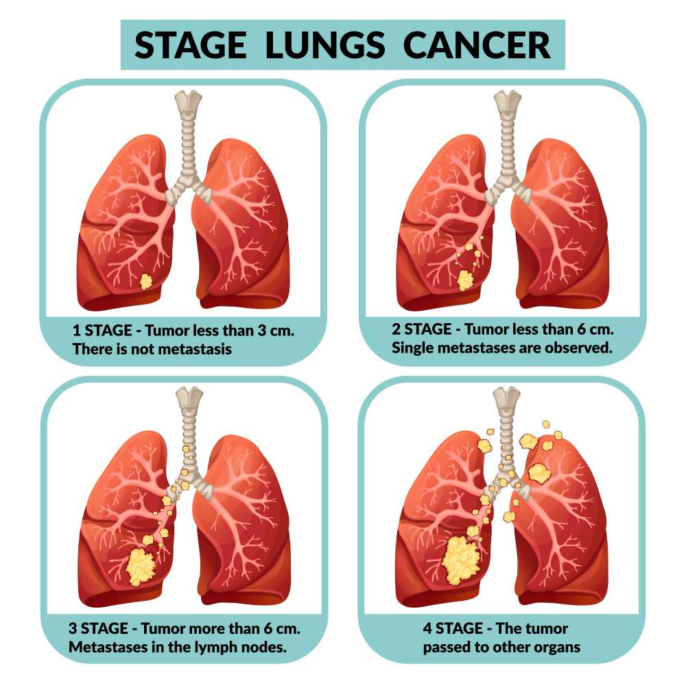 рак на белия дроб последен стадий 