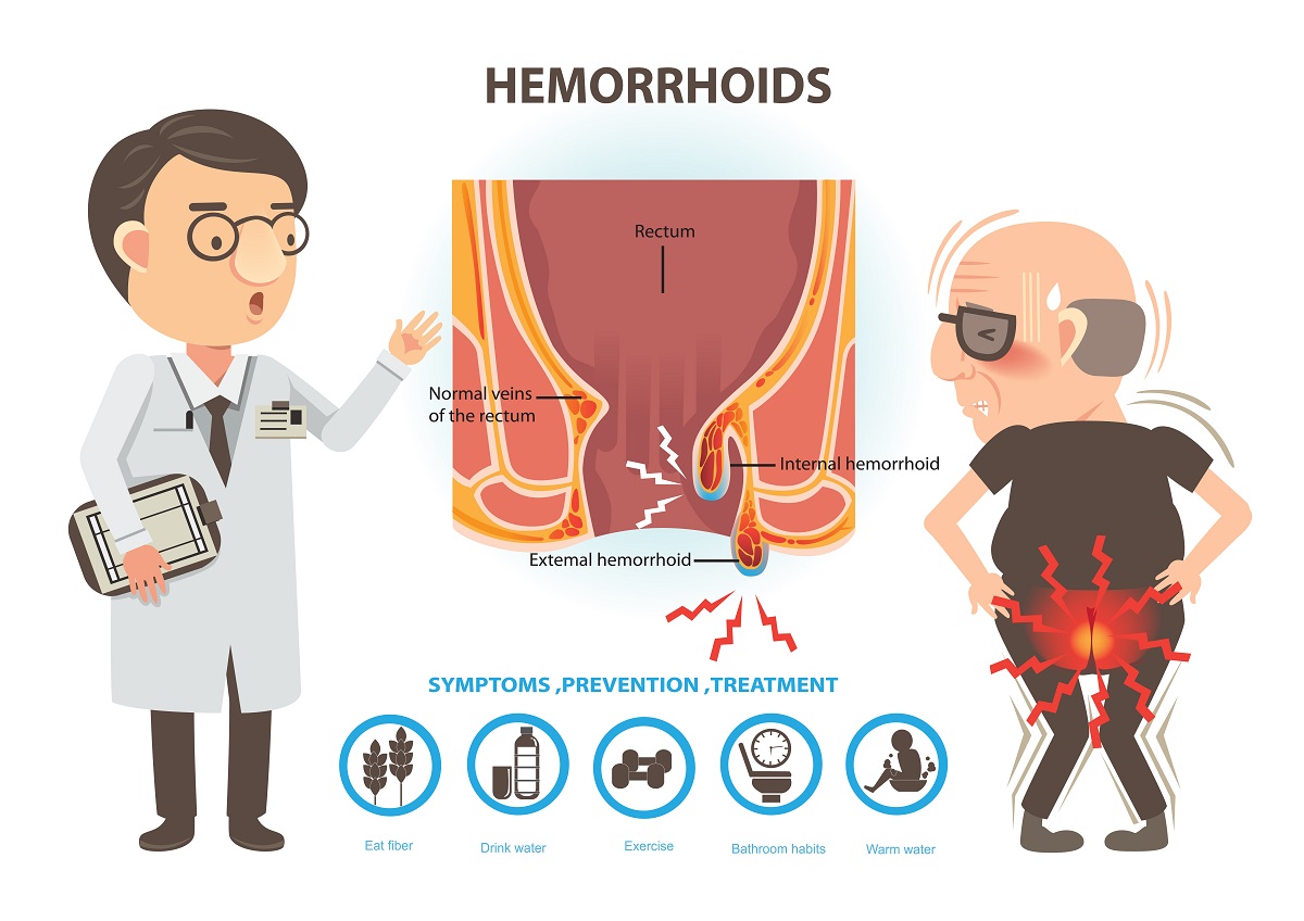 Зад хемороидите могат да се крият различни по-тежки и дори злокачествени заболявания