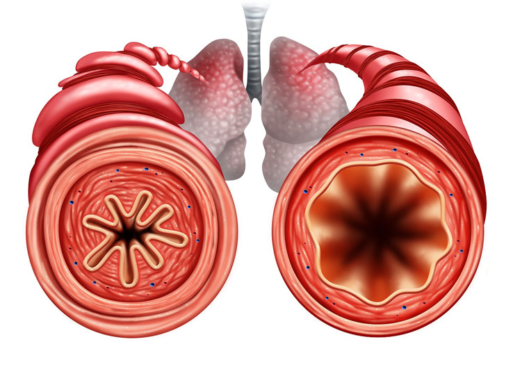 Астмата e хронично заболяване на дихателните пътища, което затруднява дишането