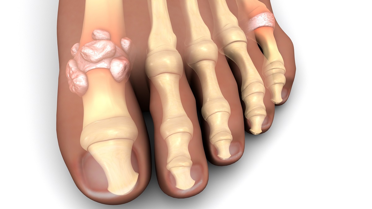 При подагра Пристъпът се характеризира със силна болка, подуване и зачервяване на ставата – най-често в зоната на палеца на стъпалото