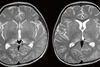 One in 100 patients hospitalized with COVID-19 likely to develop neurological complications