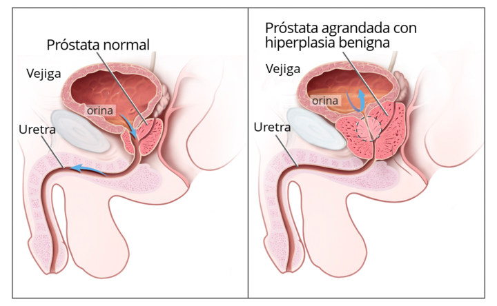 Hiperplasia benigna de próstata
