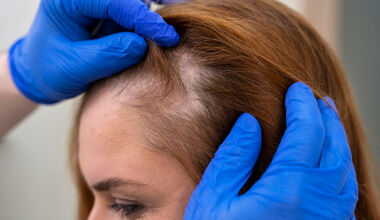 New treatments provide more options for people with alopecia areata