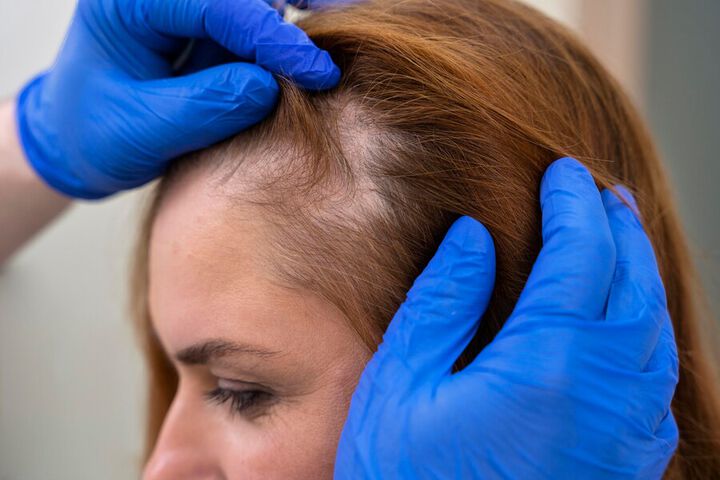 New treatments provide more options for people with alopecia areata