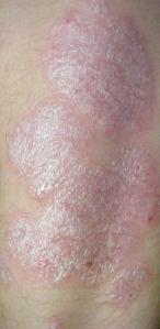 plaque psoriasis