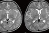 ONE IN 100 PATIENTS HOSPITALIZED WITH COVID-19 LIKELY TO DEVELOP NEUROLOGICAL COMPLICATIONS